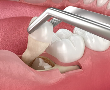 Surgical Extraction