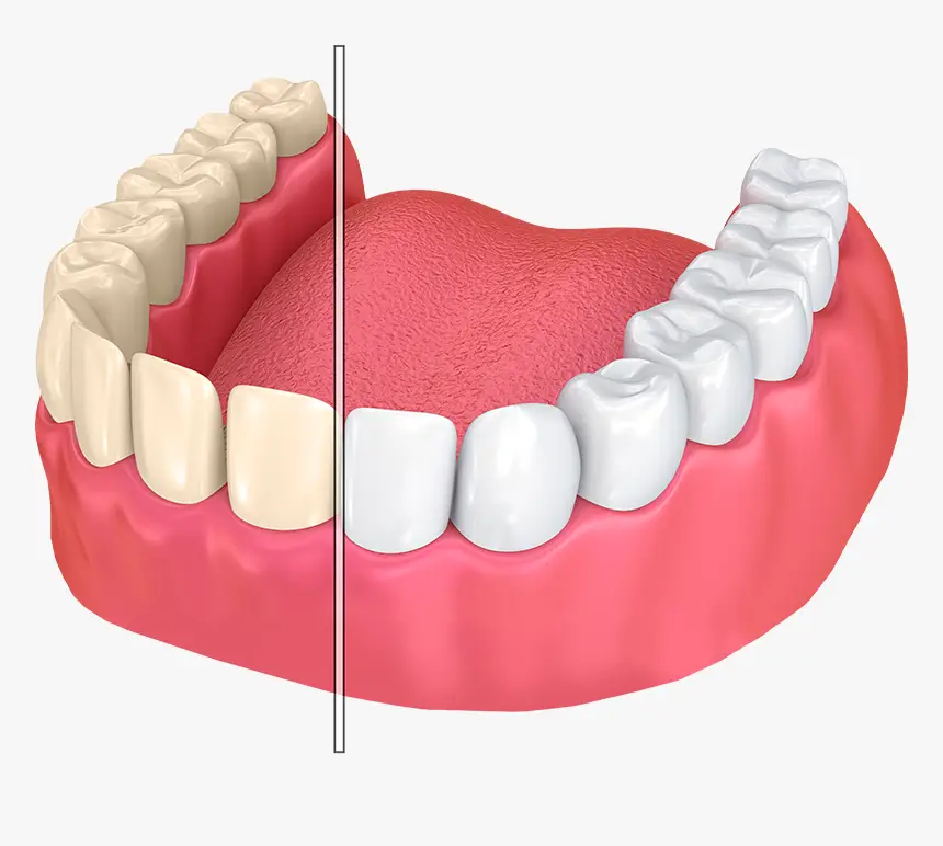 Teeth Whitening
