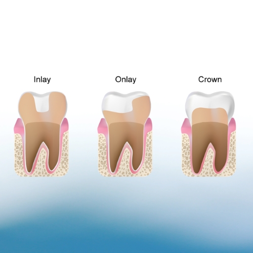 Inlay-Onlay-both-metallic-and-tooth-color